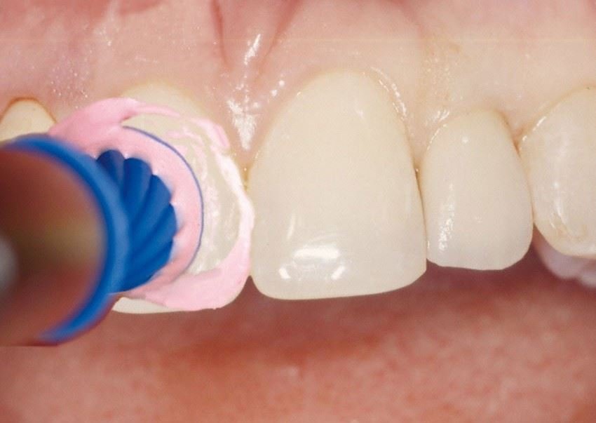 Professionelle Zahnreinigung