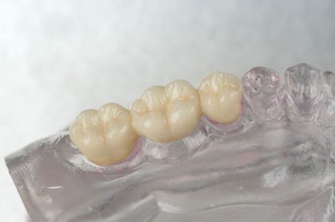 Zahnersatz vollkeramikbruecke.jpg