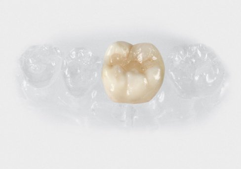 Füllungen keramikinlay.jpg